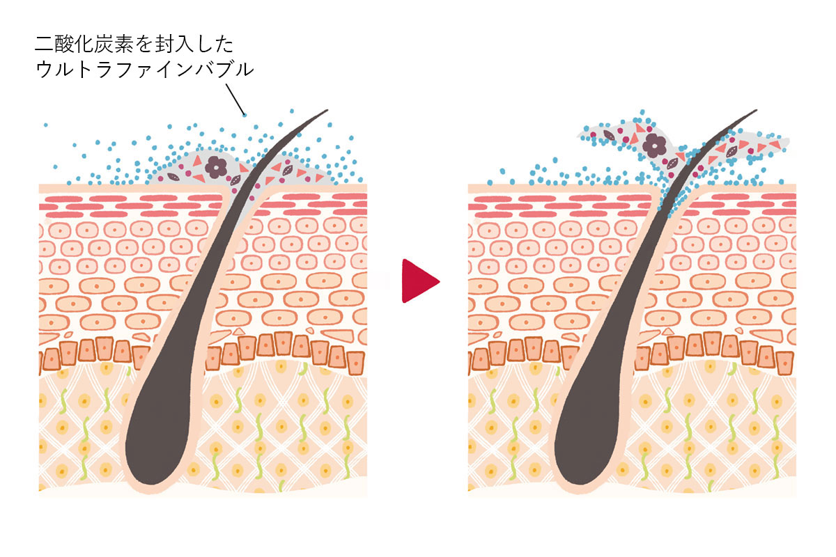 二酸化炭素のウルトラファインバブル採用